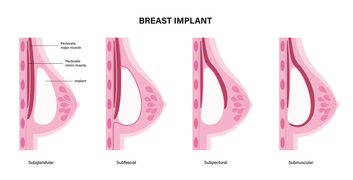 Locations for Breast Implant