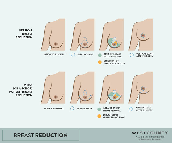 Breast Reduction Techniques