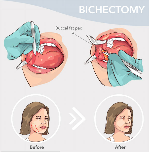 Removal of Buccal Fat Pad