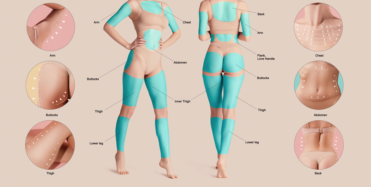 Areas Where Liposuction Can Be Performed