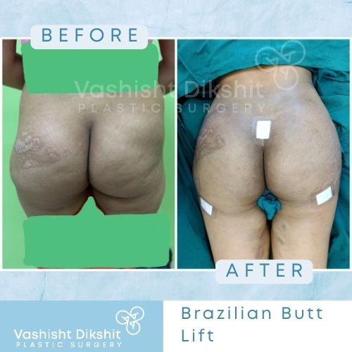 Before and After Brazilian Butt Lift surgery