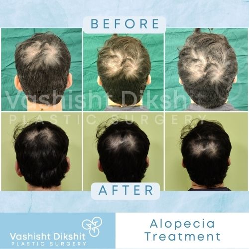 Alopecia Treatment By Recosma