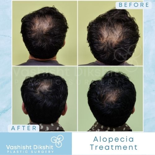 Alopecia Treatment