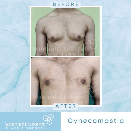 Before and After Gynecomastia Surgery 