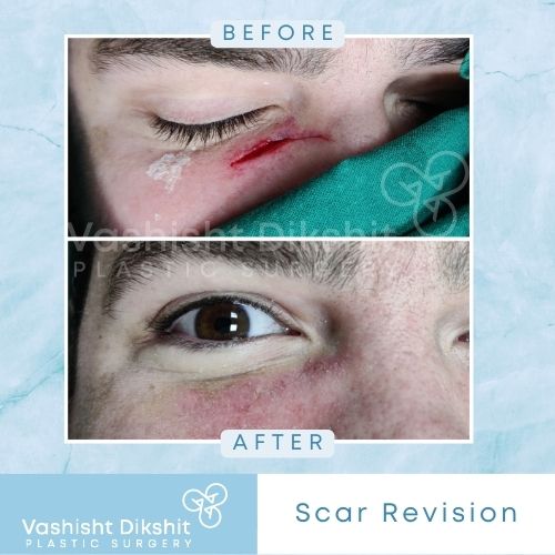 Scar Revision