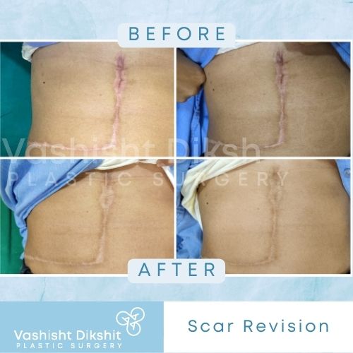 Scar Revision