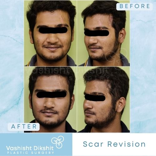 Scar Revision